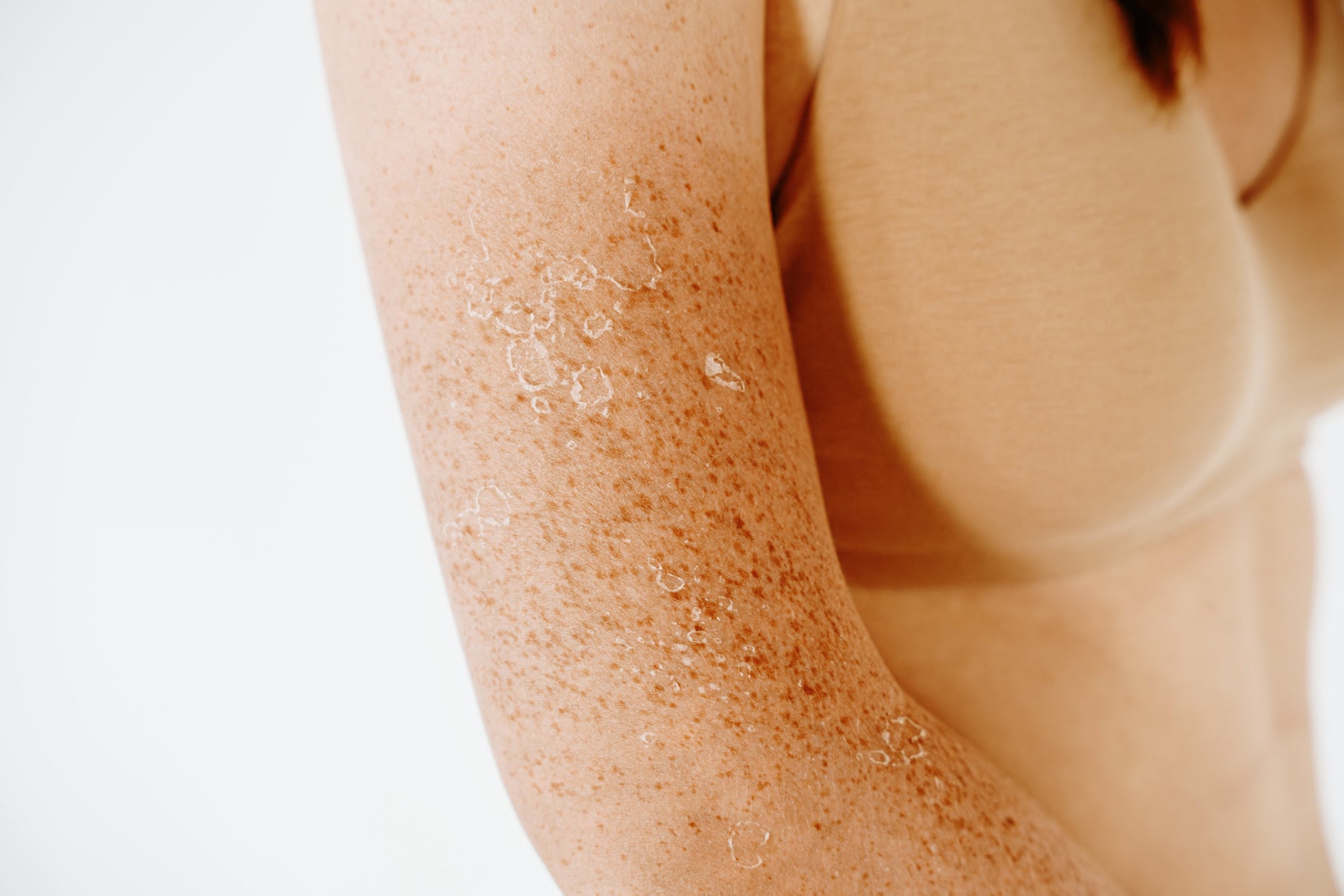 Flaky Irritated Skin